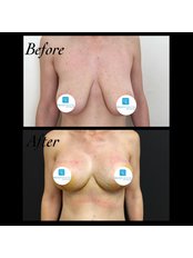 Breast Lift - Dr Erkin Onsal - Privacy Aesthetic Clinic