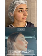 Closed Rhinoplasty - Dr Erkin Onsal - Privacy Aesthetic Clinic