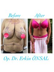 Mommy Makeover - Dr Erkin Onsal - Privacy Aesthetic Clinic