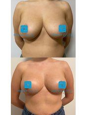 Breast Reduction - Dr Erkin Onsal - Privacy Aesthetic Clinic