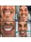 Dr. Görkem Atsal Clinic - #dentaltreatments #zirconiumcrown #crown #emax #implant #dentalimplant #dental #teeth #teethwhitening #hollywoodsmile #smiledesign #bridge #whitening #veneer 