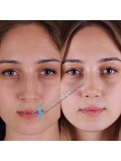 Closed Rhinoplasty Revision - Dr. Suleyman Tas MD, Aesthetic and Plastic Surgeon