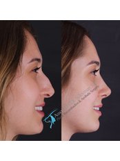 Closed Rhinoplasty Revision - Dr. Suleyman Tas MD, Aesthetic and Plastic Surgeon