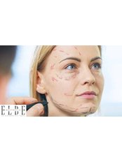 Full Facelift Surgery (Including Temporals, Midface and Neck) - ELBE Aesthetic Clinic