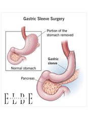 Gastric Sleeve Surgery - ELBE Aesthetic Clinic