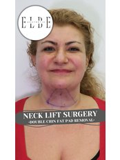 Neck Lift Surgery - ELBE Aesthetic Clinic