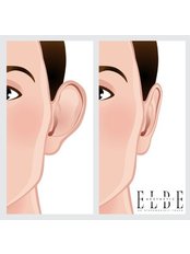 Prominent Ear (Otoplasty) - ELBE Aesthetic Clinic
