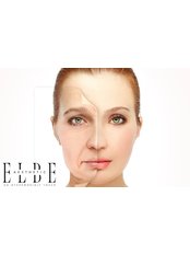 Full Facelift Surgery (Including Temporals, Midface and Neck) - ELBE Aesthetic Clinic