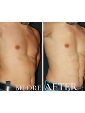 Liposuction - Esmerest Clinic