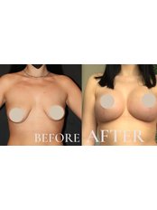 Breast Implants - Esmerest Clinic