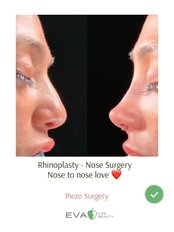 Rhinoplasty - Eva Life Beauty Clinic