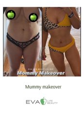 Mommy Makeover - Eva Life Beauty Clinic