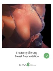 Breast Implants - Eva Life Beauty Clinic