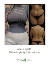 Abdominoplasty - Eva Life Beauty Clinic