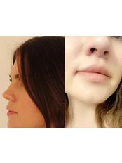 Lip Lift - Face Aesthetics Turkey