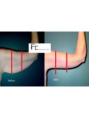 Arm Lift with Liposuction - Fatih Ceran, MD (FC Plastic Surgery Clinic)