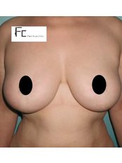 Breast Reduction - Fatih Ceran, MD (FC Plastic Surgery Clinic)