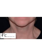 Facelift Deep plane (With necklift) - Fatih Ceran, MD (FC Plastic Surgery Clinic)