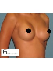 Breast Implants - Fatih Ceran, MD (FC Plastic Surgery Clinic)