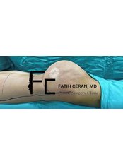 BBL - Brazilian Butt Lift - Fatih Ceran, MD (FC Plastic Surgery Clinic)