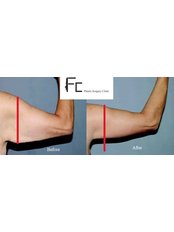 Arm Lift with Liposuction - Fatih Ceran, MD (FC Plastic Surgery Clinic)