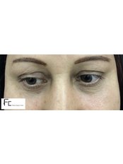 Eyelid Surgery - Fatih Ceran, MD (FC Plastic Surgery Clinic)