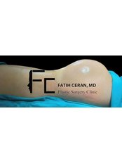 Butt Implants - Fatih Ceran, MD (FC Plastic Surgery Clinic)