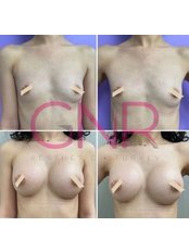 Breast Implants - GNR Aesthetic