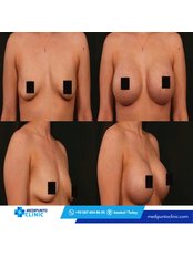 Breast Implant Revision - Medipunto Clinic