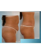 Liposuction - Medipunto Clinic