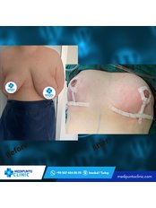 Breast Reduction - Medipunto Clinic