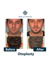 Otoplasty - MEDULUX HEALTH