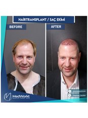Hair Transplant - Medworkt Health