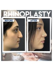 Rhinoplasty - Medworkt Health