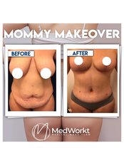 Mommy Makeover - Medworkt Health
