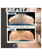 Breast Lift - Medworkt Health