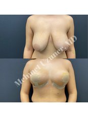 Breast Lift - Op Dr Mehmet Uzuner