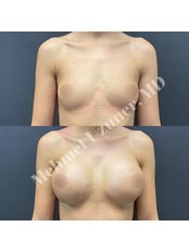 Breast Implants - Op Dr Mehmet Uzuner