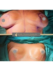 Breast Reduction - Op. Dr. Teoman Eraslan