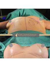 Breast Implants - Op. Dr. Teoman Eraslan