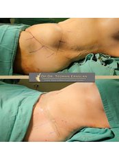 Liposuction - Op. Dr. Teoman Eraslan