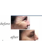 Treatment for Wrinkles - Op. Dr. Teoman Eraslan