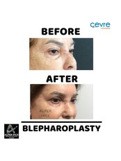 Blepharoplasty - Private Cevre Hospital