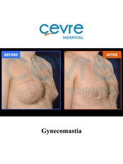 Gynecomastia - Private Cevre Hospital
