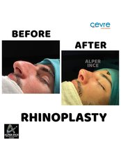 Rhinoplasty - Private Cevre Hospital