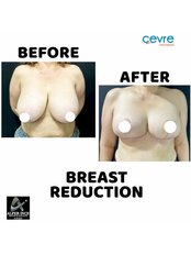 Breast Reduction - Private Cevre Hospital