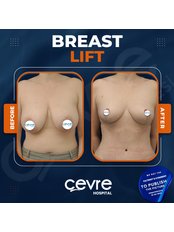 Breast Lift - Private Cevre Hospital