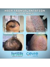 Sapphire Hair Transplant - Private Cevre Hospital