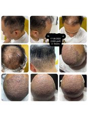 DHI - Direct Hair Implantation - Private Cevre Hospital
