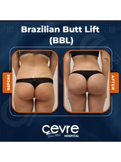 BBL - Brazilian Butt Lift - Private Cevre Hospital